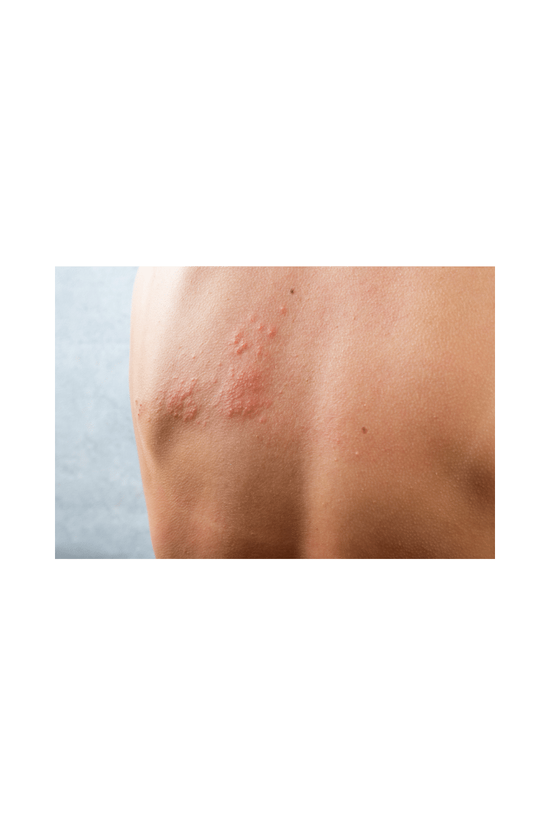 What are Shingles? Am I at Risk? – Physician’s Express Care